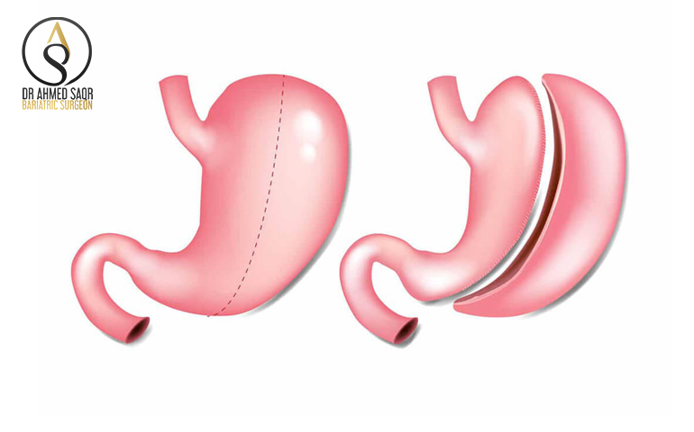 إنقاص أكثر من ٦٠٪ من الوزن الزائد
